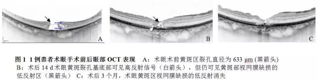 玻璃体移植,玻璃体切除联合手术