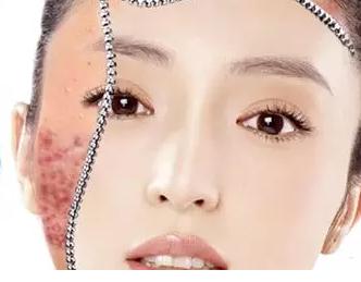 过敏肌肤如何修复肌底,过敏肌适合什么护肤