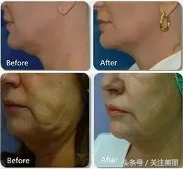 为什么热拉提这么便宜,热拉提多久做一次效果好