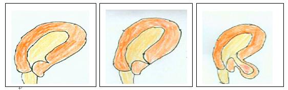 科普:什么叫子宫瘢痕憩(qi)室