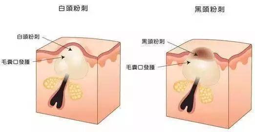 “闭口”这么烦人该如何解决？种草这些好物！