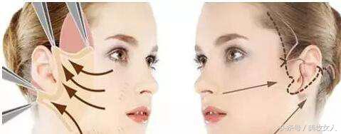 线雕小切口面雕拉皮的区别,线雕与拉皮术