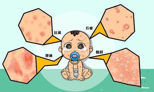 婴儿湿疹快速消除的办法,婴儿湿疹快速消除小窍门