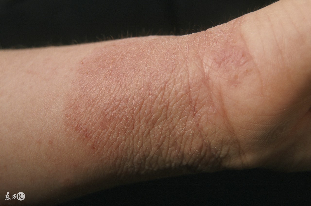 如何分辨过敏性湿疹和热的湿疹,怎样判断湿疹是否是过敏性湿疹