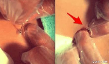 黑痣用针挑了会留疤吗,长黑痣用什么药去掉