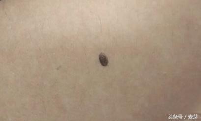 黑痣用针挑了会留疤吗,长黑痣用什么药去掉