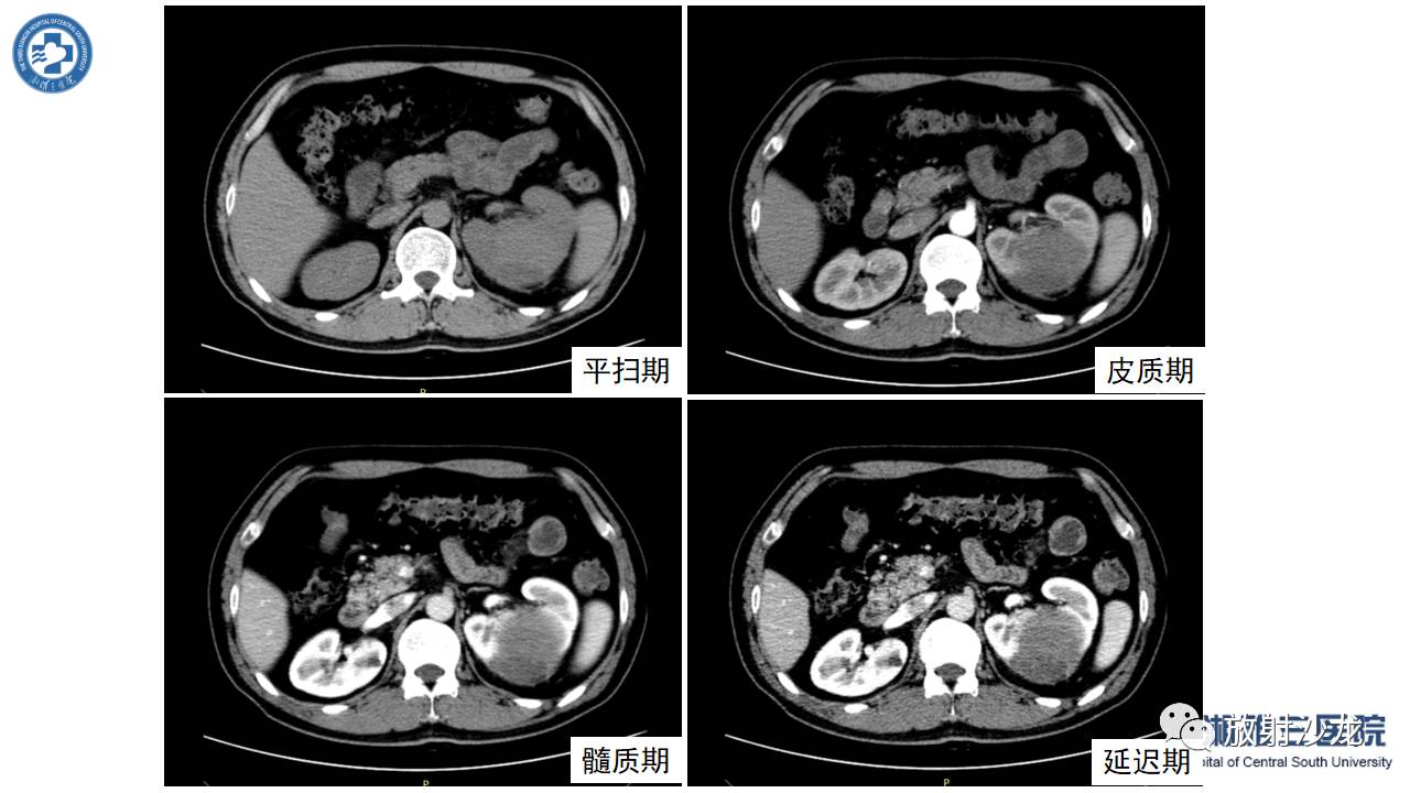 左腰侧边撞伤里面隐隐作痛,左腰被撞现在肚子痛