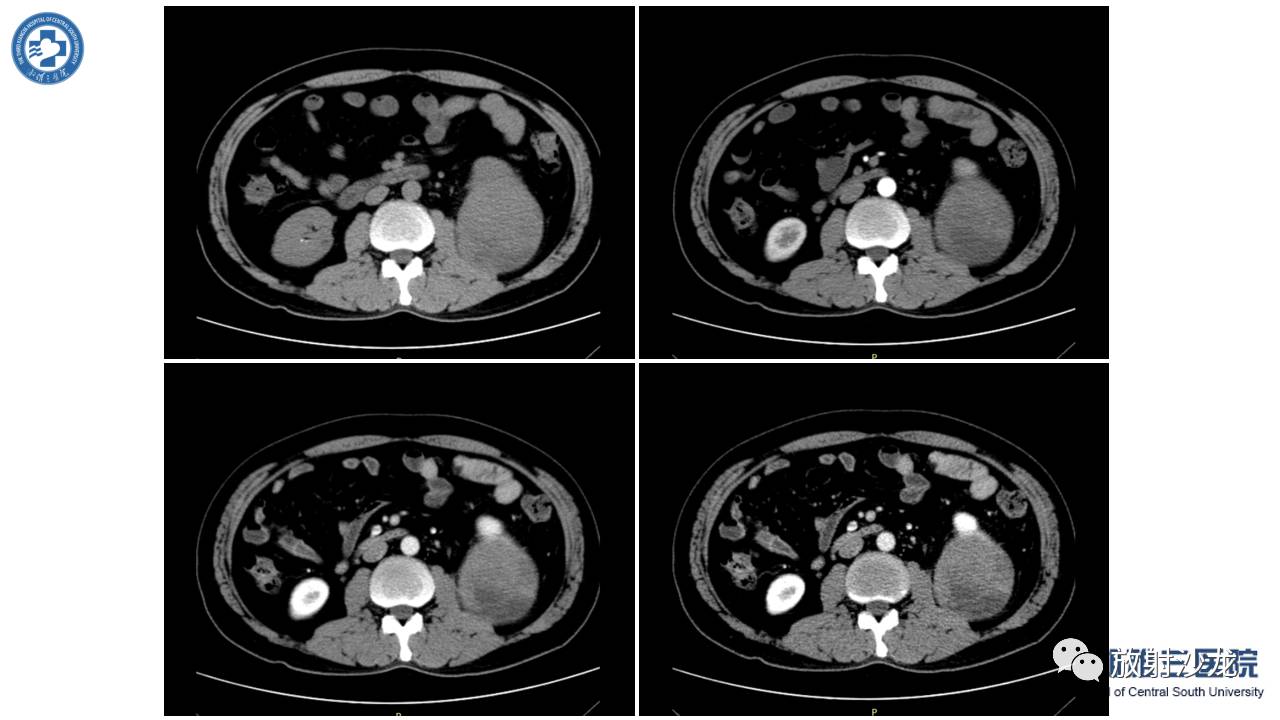 左腰侧边撞伤里面隐隐作痛,左腰被撞现在肚子痛