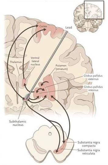 帕金森病手抖很严重怎么解决,帕金森病不只是老年人的疾病