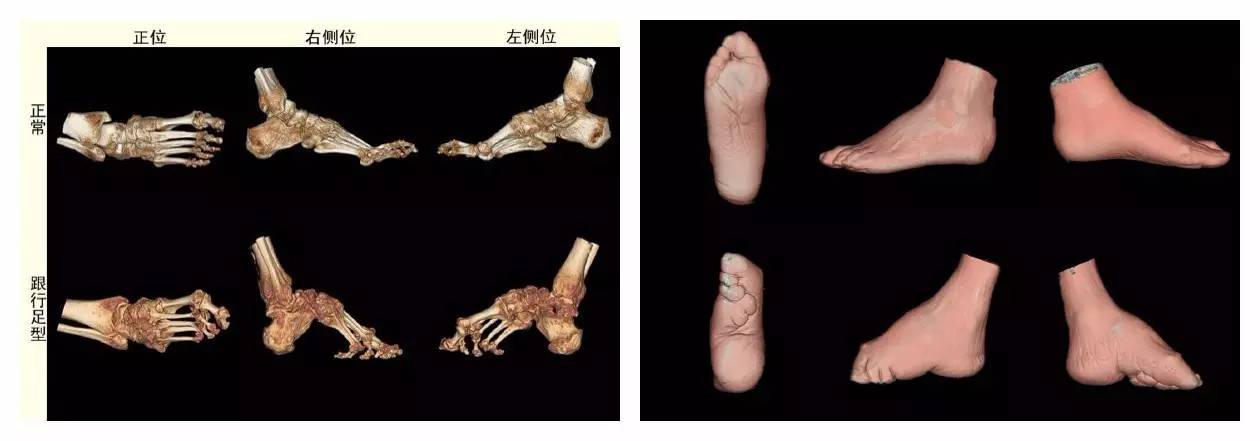 裹小脚的故事,最近的裹小脚事件