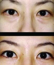 两种方法清除眼袋,目前最好的去眼袋方法