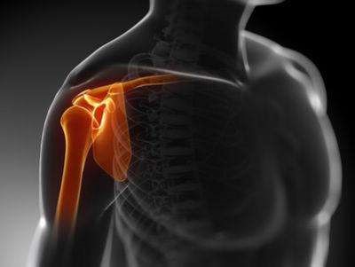 肱骨近端骨折肩关节置换手术指征,肱骨近端骨折内固定康复动作