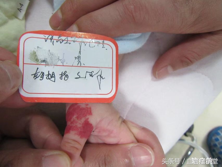 口服普萘洛尔治疗血管瘤的副作用,普萘洛尔口服液能治疗血管瘤吗