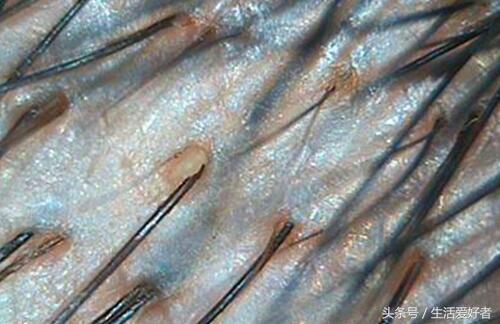 脂溢性脱发最新突破,脂溢性脱发最新研究成果