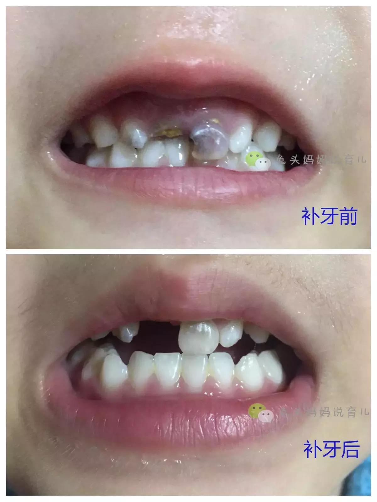 带孩子看牙医怎么不被坑,带孩子看牙花钱