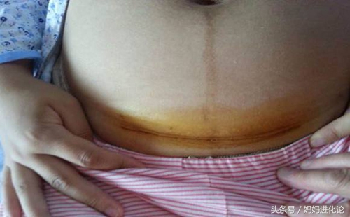 产后按压肚子排恶露,生完孩子压肚子排恶露疼哭