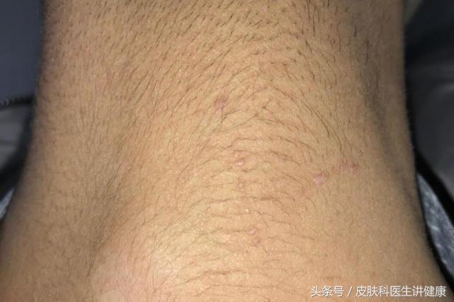 扁平疣需要治疗吗,治疗扁平疣的药膏