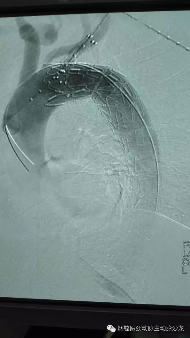 胃动脉溃疡,胃溃疡的溃疡点在主动脉