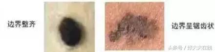 黑色胎记手术切除后还会癌变吗,孩子脸上有棕褐色胎记会癌变吗