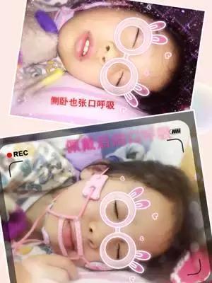 纠正张嘴呼吸会变丑的方法,张嘴睡觉鼻子呼吸会变丑吗