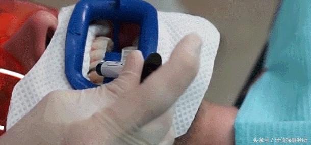 牙齿美白和冷光美白有啥区别,牙齿黄了很多年冷光美白仪有用吗