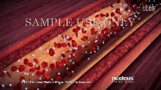 不做支架不搭桥中医调理冠心病,冠心病支架和搭桥的条件