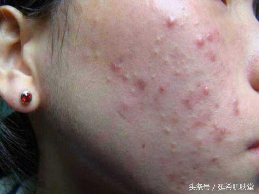 换季就长痘什么原因,一到换季就长痘怎么回事