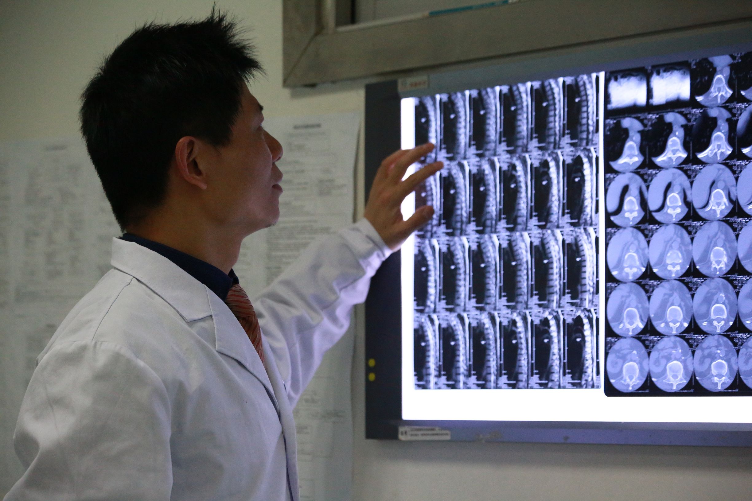 中医专家讲腰椎滑脱,腰椎滑脱手术后遗症有多严重