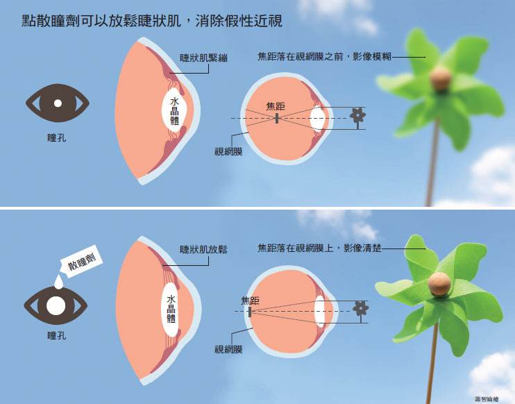 为啥医生验光比散瞳度数低,为什么医生建议散瞳
