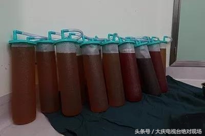 老妇挺“孕肚”负重三载就医成功摘除70斤重盆腔肿物