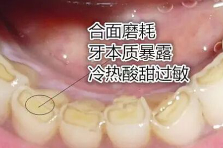 成人半夜磨牙咯吱响是什么原因,磨牙咯吱响是怎么回事