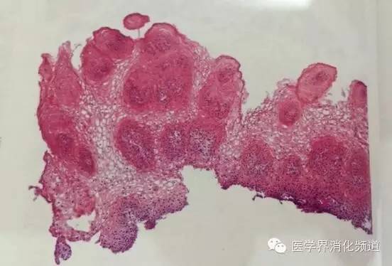 食管良性肿瘤科普视频,食管乳头状瘤和增生区别