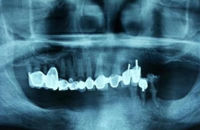 美容冠美牙效果,7天快速矫正靠谱吗