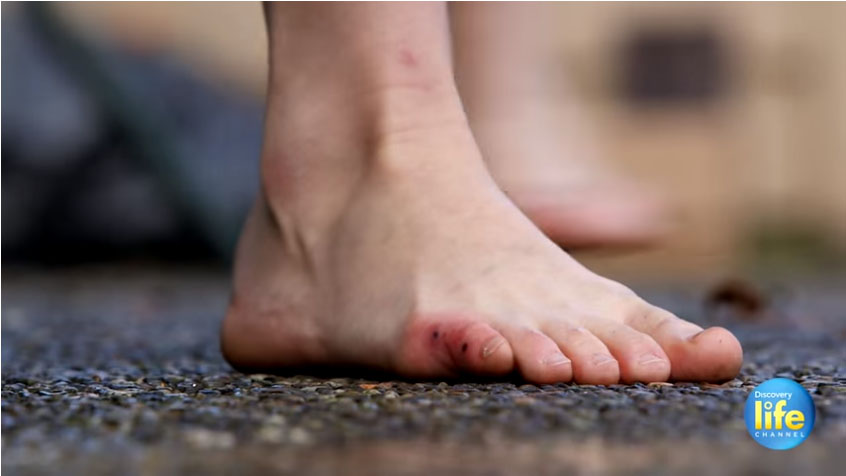 孕妇被毒蛇咬伤,怀孕被毒蛇咬了脖子和手怎么回事