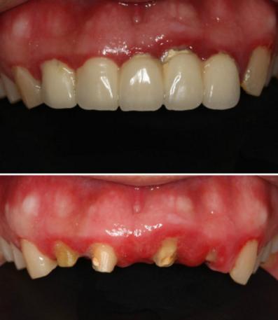美容冠美牙效果,7天快速矫正靠谱吗