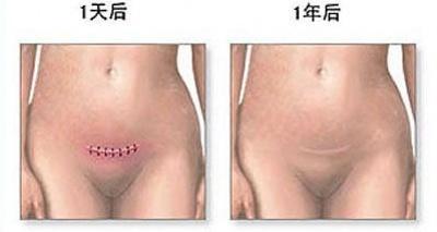 经历了剖腹产才知道妈妈的不容易,看了剖腹产才明白妈妈是多么伟大