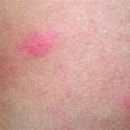 急性麻疹看医生要多少钱,治疗麻疹的小方法