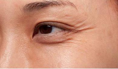 做什么动作可以改善男士鱼尾纹,简单易学一分钟赶走鱼尾纹