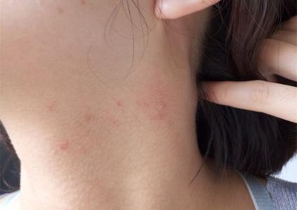 脖子上长了很多小颗粒怎么调理,脖子会出现各种症状及原因