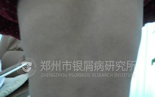 银屑病绝不能忌口,银屑病真的不能用激素么