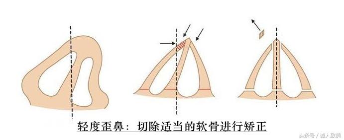 在家如何矫正歪鼻梁,歪鼻梁怎么修容