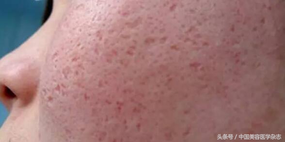 痘坑怎么修复最好方法,痘坑如何形成的怎么治疗