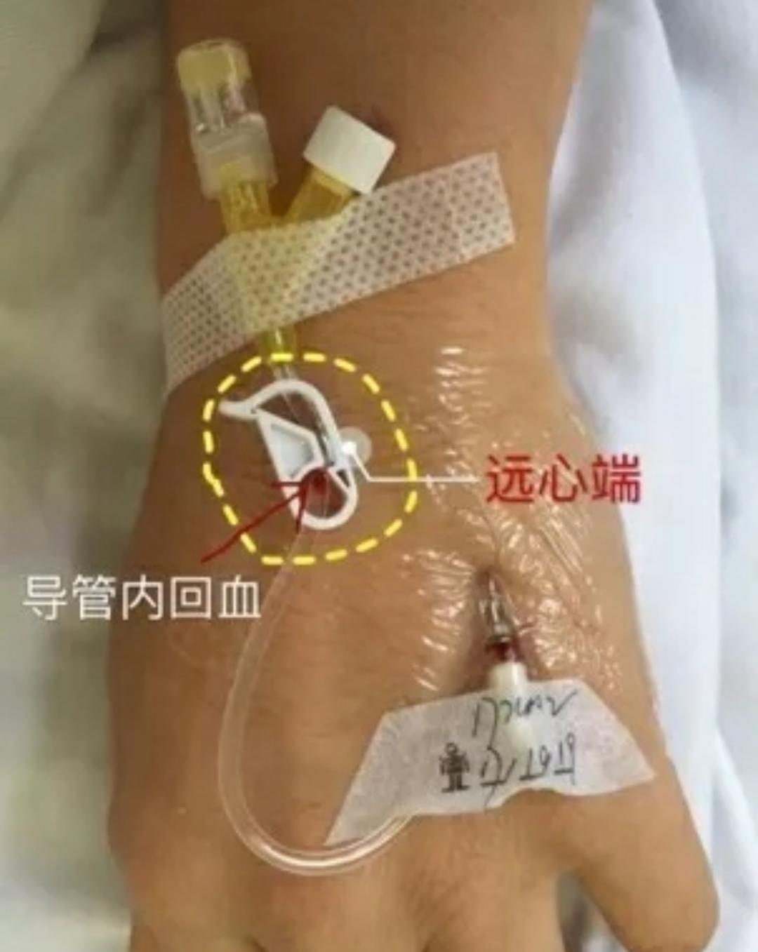 拔套管针后注意事项,套管针正常几天换一次