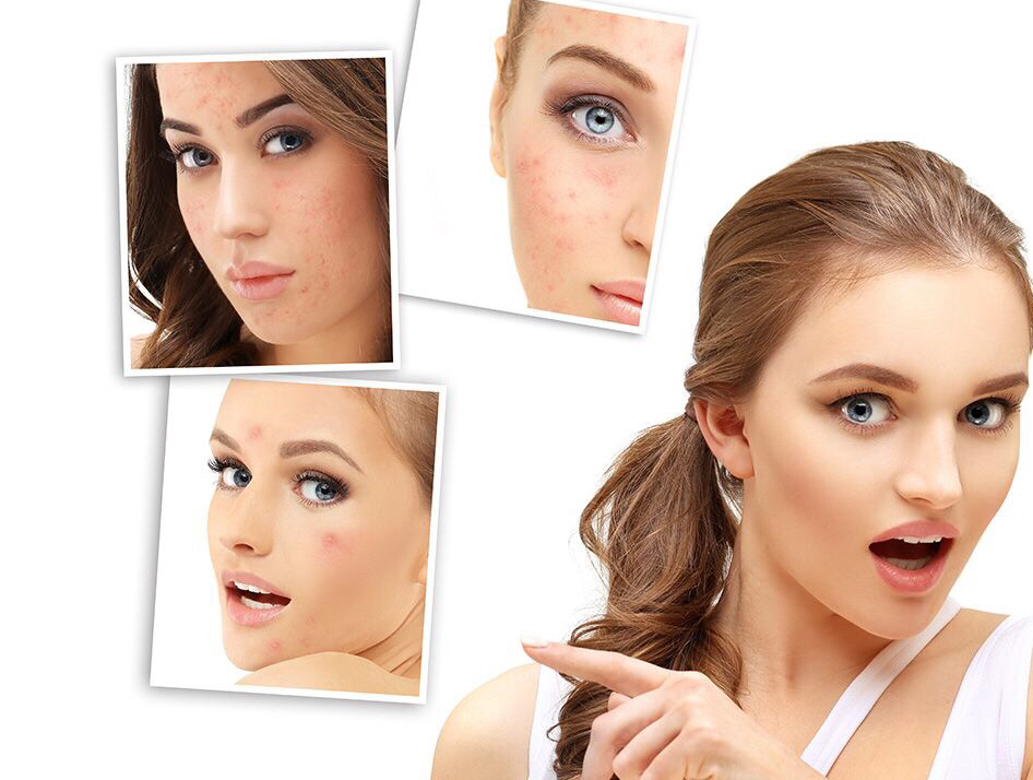 用药片涂脸祛痘,祛痘小妙招药片