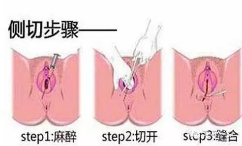 顺产也要挨一刀是真的吗,顺产为什么风险大