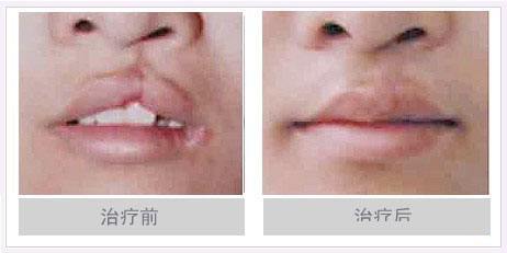 李嫣先天兔唇,天生唇腭裂的李嫣