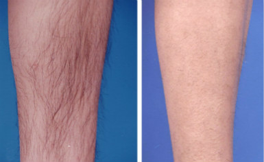 脱毛最佳时机就是现在,冬天脱毛还是夏天脱毛效果好