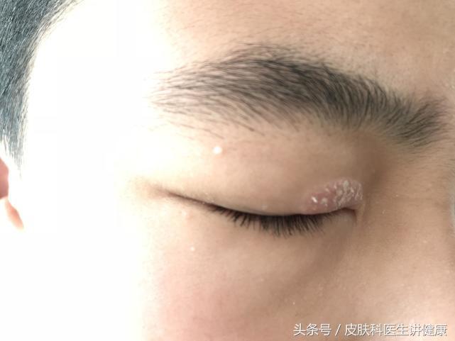 神经性皮炎初期可见瘙痒和皮疹,慢性皮疹和神经性皮炎的鉴别