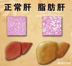 转氨酶高血脂高要注意什么,转氨酶高注意吃什么食物好