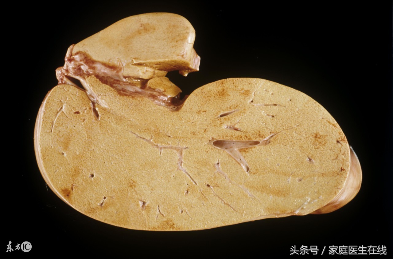 身体如果有几个症状别不当回事,有这4个症状说明肝脏有问题